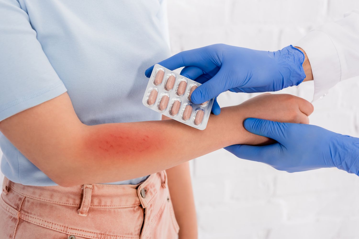 Drug allergy